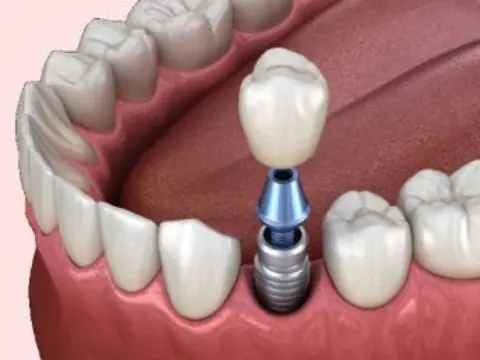 Dental Implants 