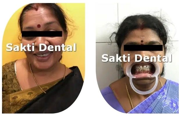 Adult Orthodontics & Braces for Adults | Sakti Dental