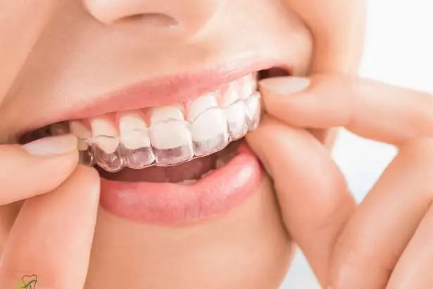 Clear Aligners
