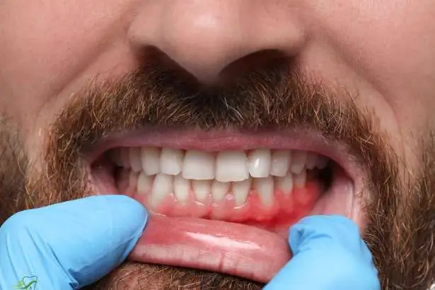 Gum Treatment