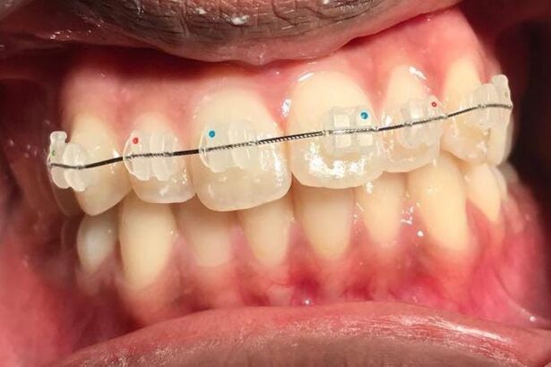 Invisible Braces Treatment
